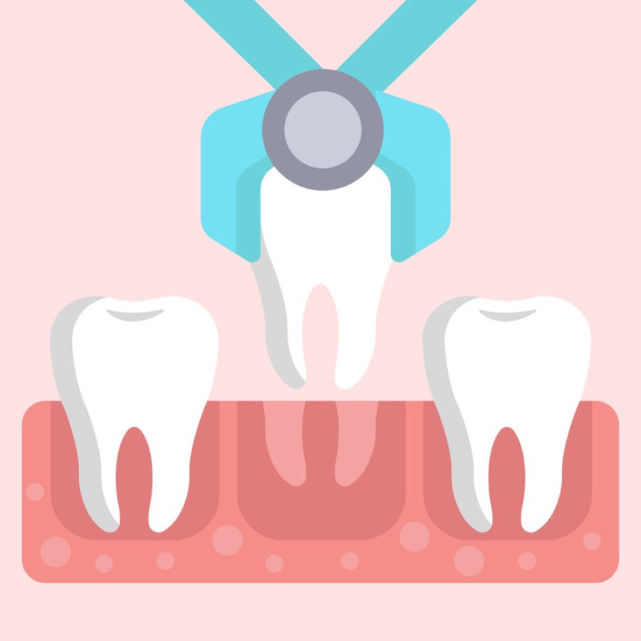 Illustration of a tooth extraction offered at ross dental